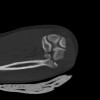 SPORK, NICO - 22.03.1976 - 02.08.2022 - CT obere Extremität - 18:02:23
